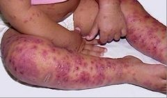 ���ӻ���ʪ���ʲô�ȽϺ�